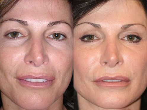 before and after plasma rejuvenation of the skin