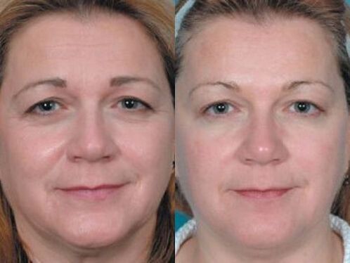 photographs before and after plasma skin rejuvenation