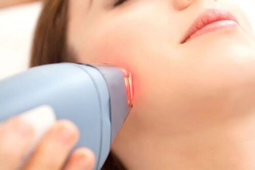 Laser epilation for facial skin