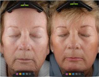 Before and after rejuvenation with fractional laser
