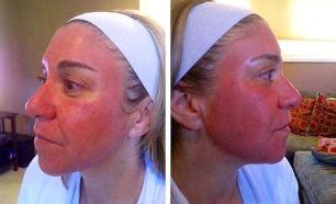 Redness on the face after laser rejuvenation
