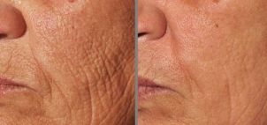 photo before and after fraction skin rejuvenation