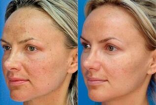 photograph before and after skin rejuvenation with the device